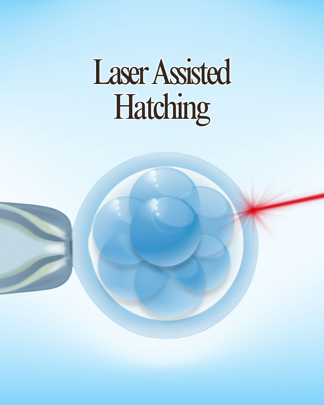 Laser Assisted Hatching