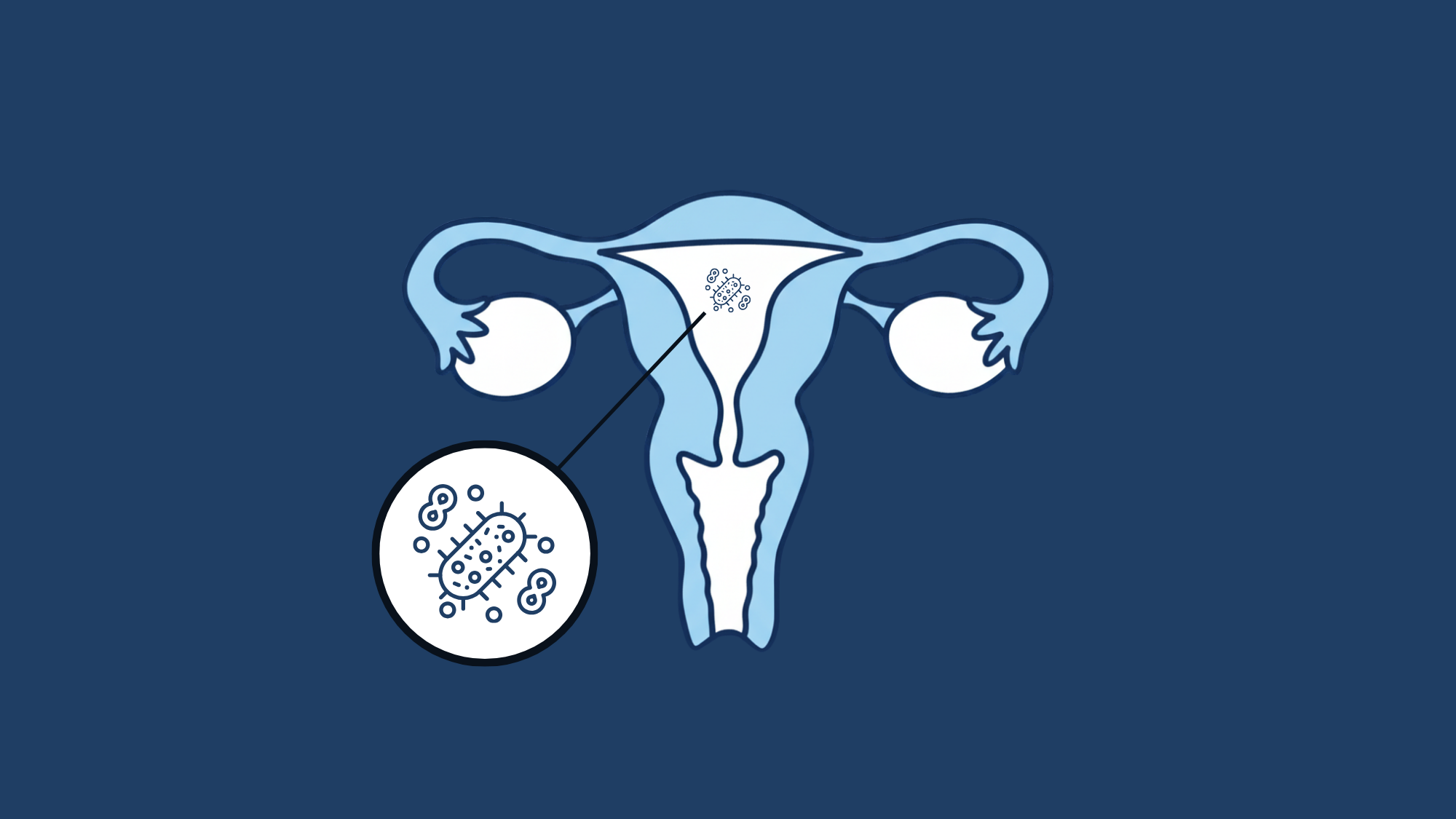 ALICE – Analysis of Infectious Chronic Endometritis